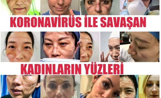 Koronavirüsle Savaşan Kadınların Yüzü Maske İziyle Yaralanıyor