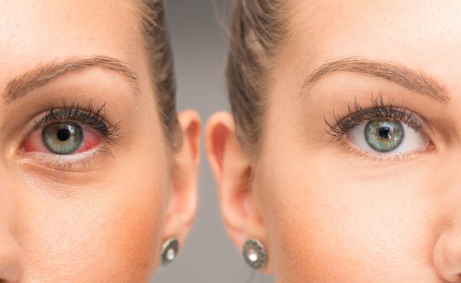Pandemide Göz Şikayetleri Özellikle Göz Migreni Artıyor